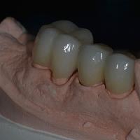 Teeth Retainer After Braces image 4